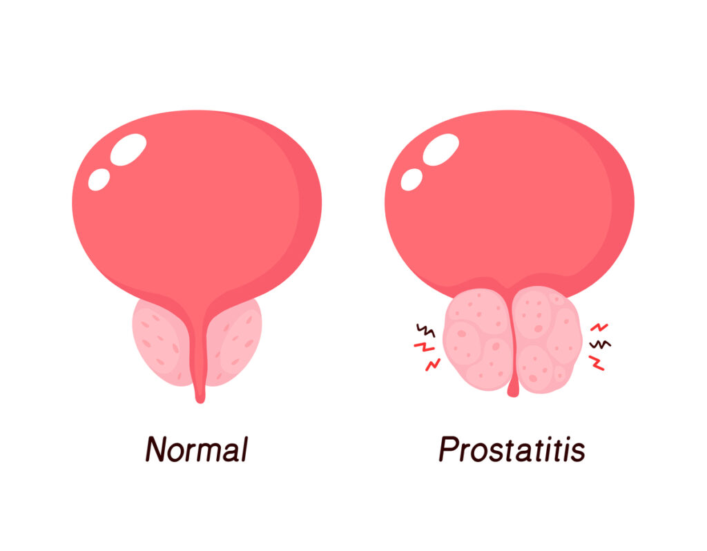 próstata